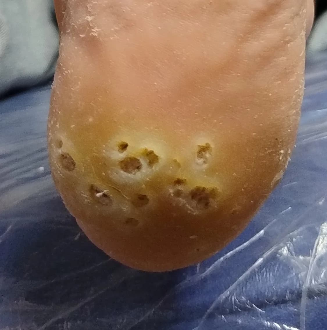 Cheratolisi puntata